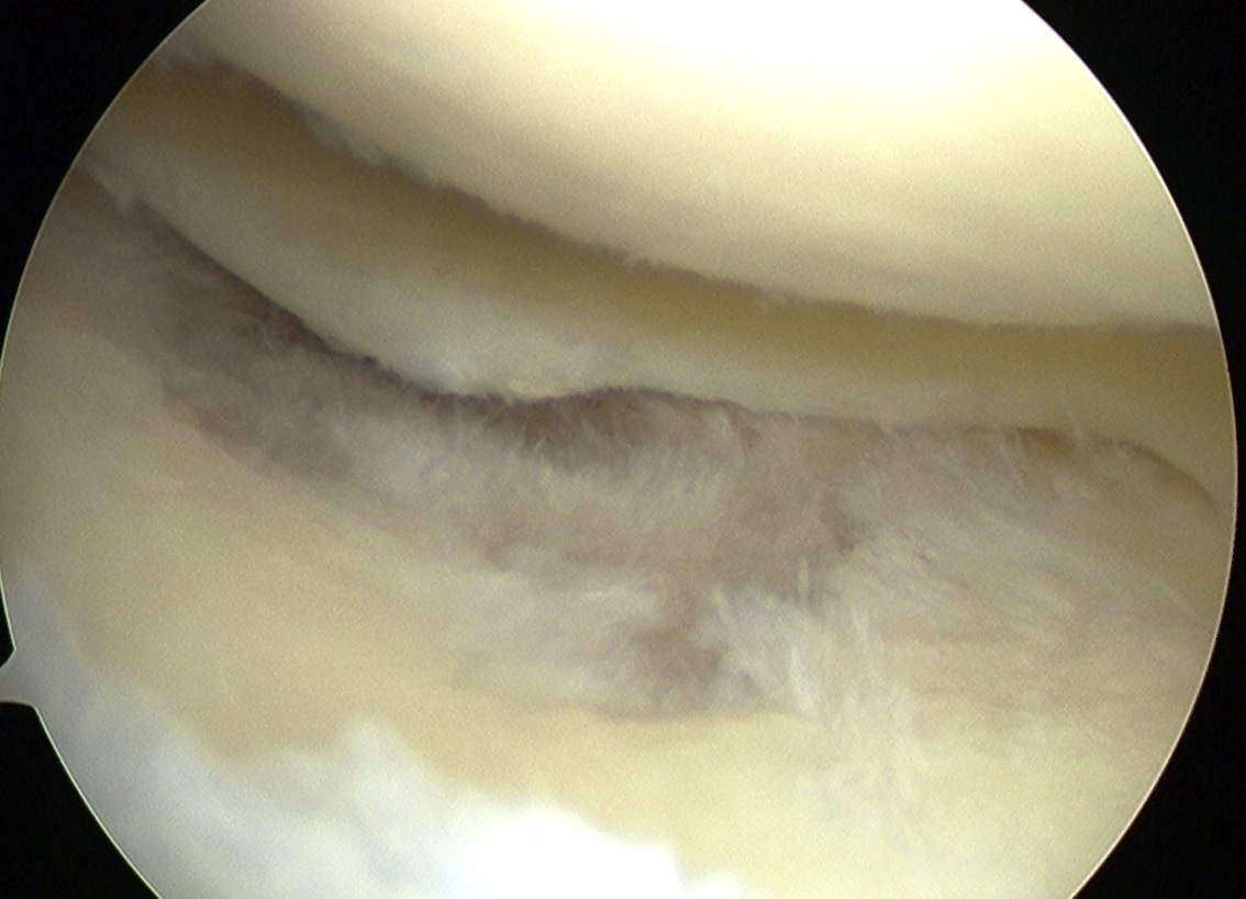 Grade 3 Chondral Injury